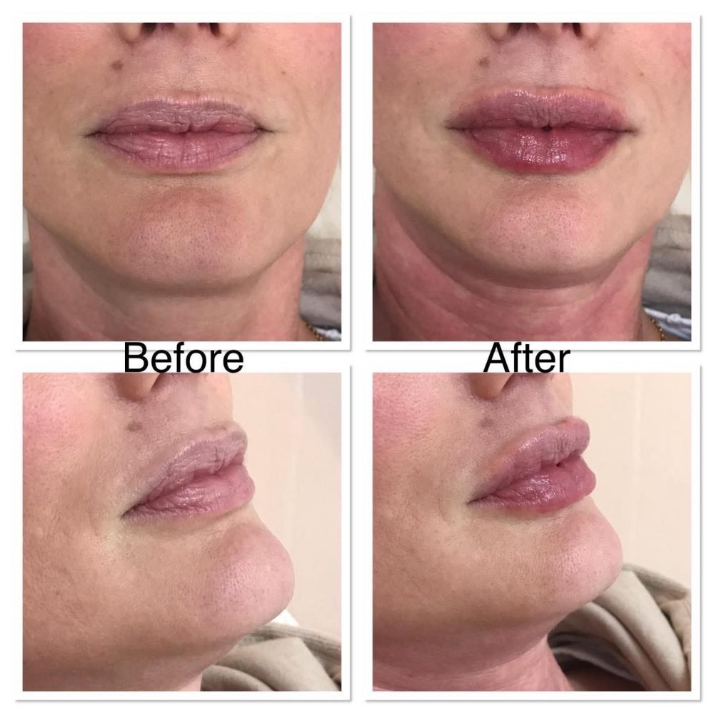 Before and after of lip fillers, beauty salon